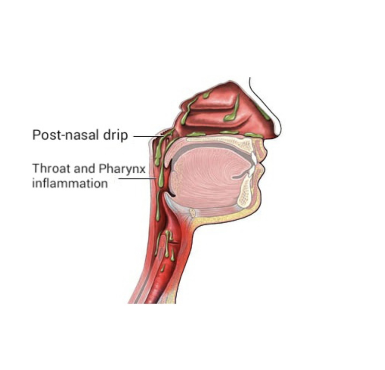 Managing Post-Nasal Drip: Effective Treatments 2